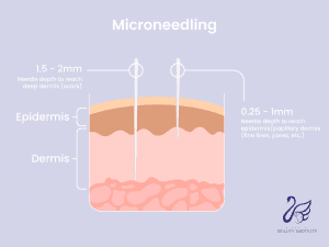 graphic of skin layers and needle depth of microneedling